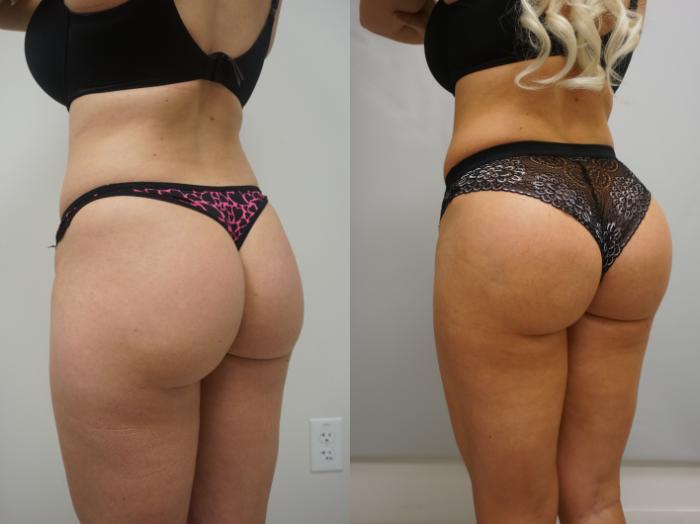 Brazilian Butt Lifts